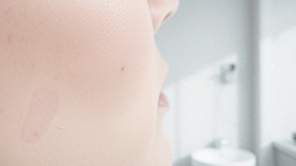 Kiedy zaczynamy widzieć efekty po zabiegu RF mikroigłowej?
